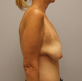 Breast Lift Before & After Image