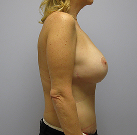 Breast Lift Before & After Image