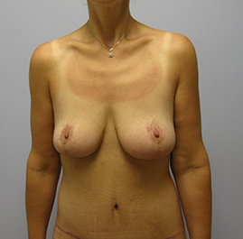 Breast Lift Before & After Image