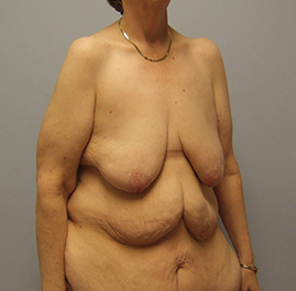 Breast Lift Before & After Image