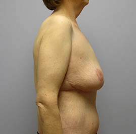 Breast Lift Before & After Image