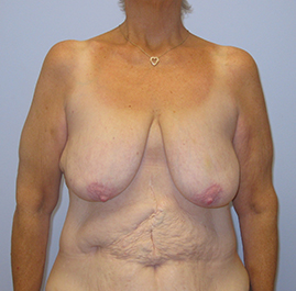 Breast Lift Before & After Image