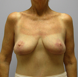 Breast Lift Before & After Image