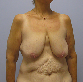 Breast Lift Before & After Image