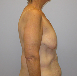 Breast Lift Before & After Image