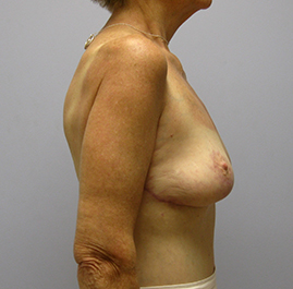 Breast Lift Before & After Image