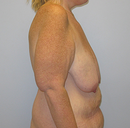 Breast Lift Before & After Image