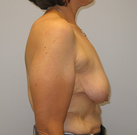 Breast Lift Before & After Image