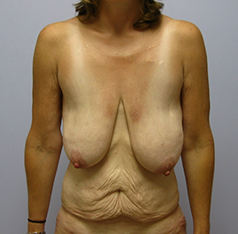 Breast Lift Before & After Image