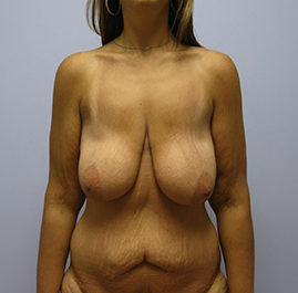 Breast Lift Before & After Image