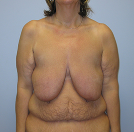 Breast Lift Before & After Image