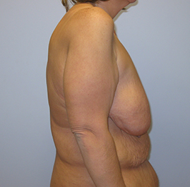 Breast Lift Before & After Image