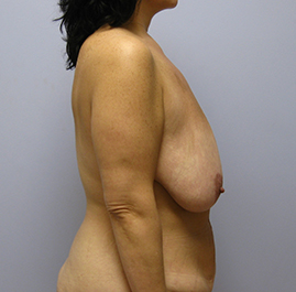 Breast Lift Before & After Image