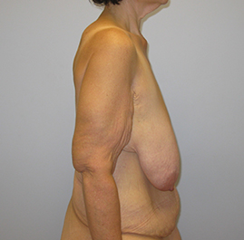 Breast Lift Before & After Image