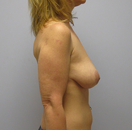 Breast Lift Before & After Image