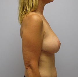 Breast Lift Before & After Image