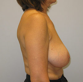 Breast Lift Before & After Image