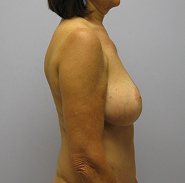 Breast Lift Before & After Image