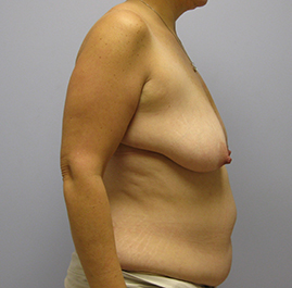 Breast Lift Before & After Image