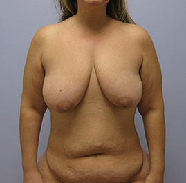 Breast Lift Before & After Image