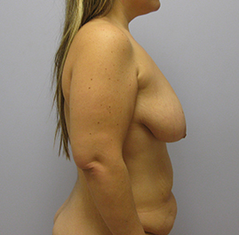 Breast Lift Before & After Image