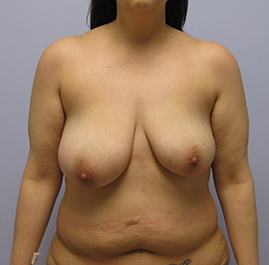 Breast Lift Before & After Image