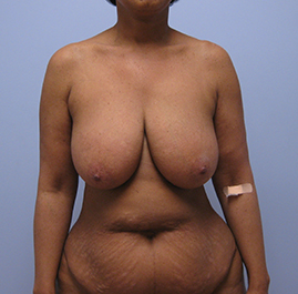 Breast Lift Before & After Image