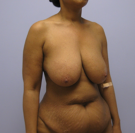 Breast Lift Before & After Image