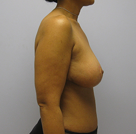 Breast Lift Before & After Image