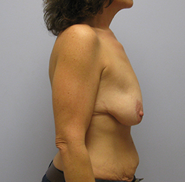 Breast Lift Before & After Image