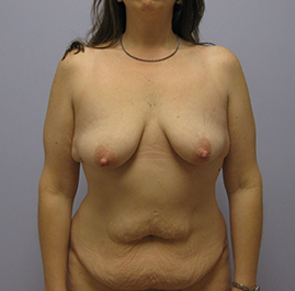 Breast Lift Before & After Image