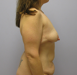 Breast Lift Before & After Image