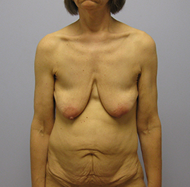 Breast Lift Before & After Image