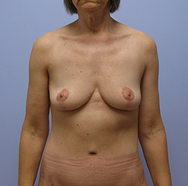 Breast Lift Before & After Image