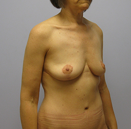 Breast Lift Before & After Image