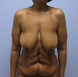 Breast Lift Before & After Image