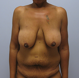 Breast Lift Before & After Image