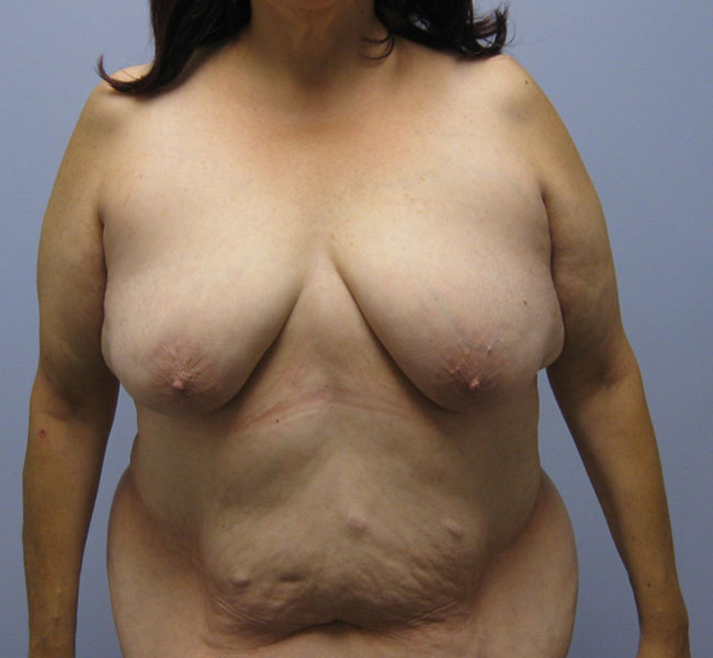 Breast Lift Before & After Image