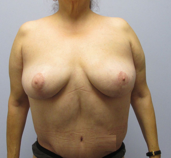 Breast Lift Before & After Image