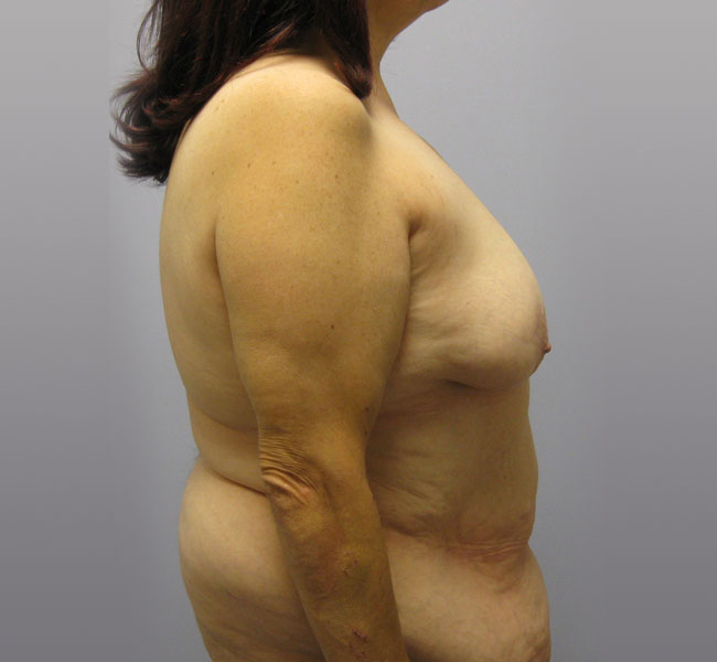 Breast Lift Before & After Image