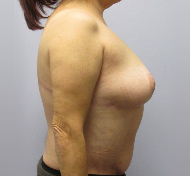 Breast Lift Before & After Image