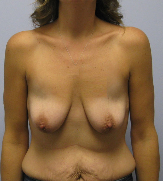 Breast Lift Before & After Image