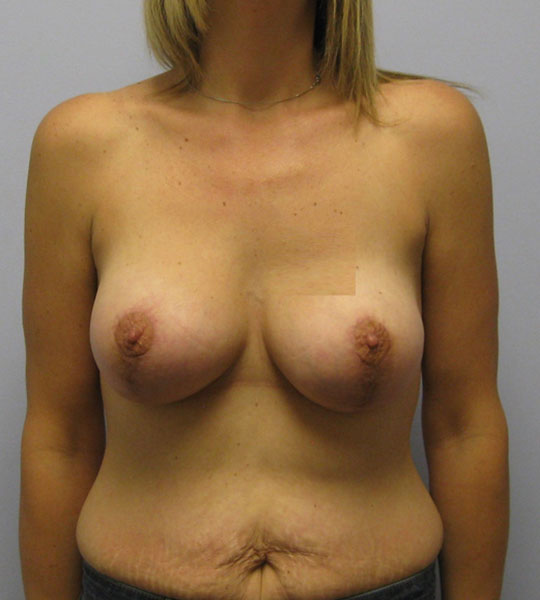 Breast Lift Before & After Image