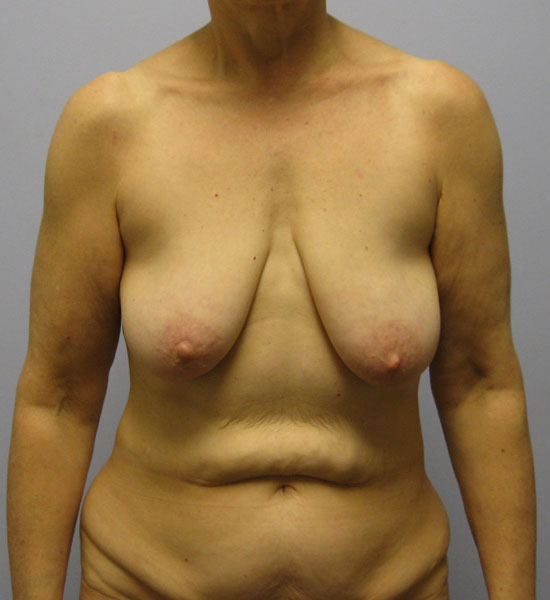 Breast Lift Before & After Image