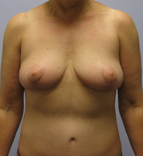 Breast Lift Before & After Image