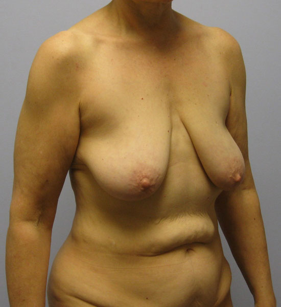 Breast Lift Before & After Image