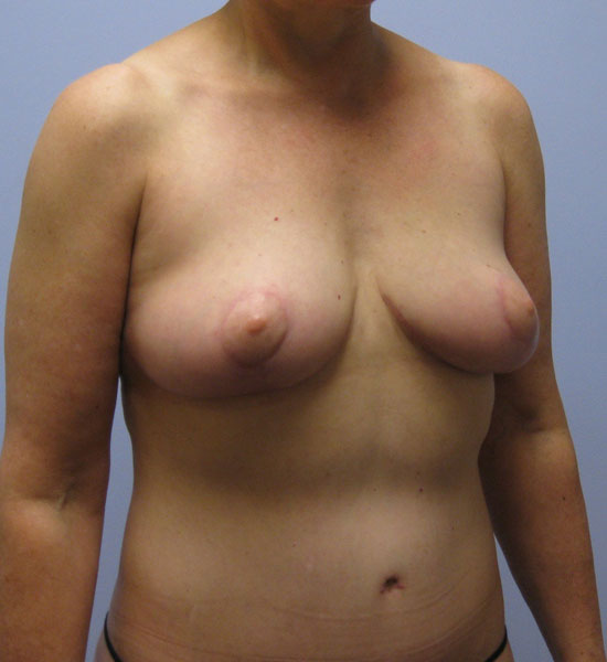 Breast Lift Before & After Image