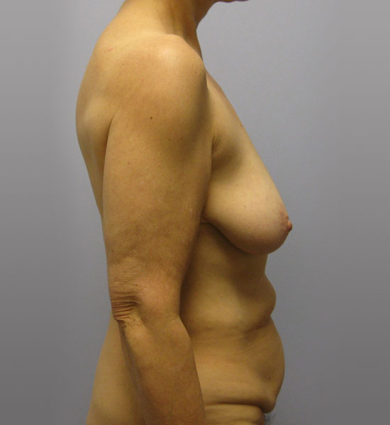 Breast Lift Before & After Image