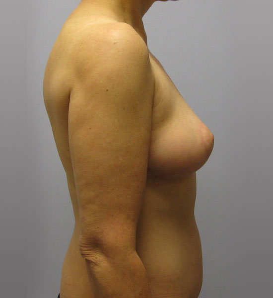 Breast Lift Before & After Image