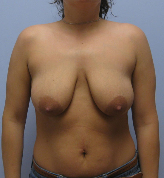 Breast Lift Before & After Image